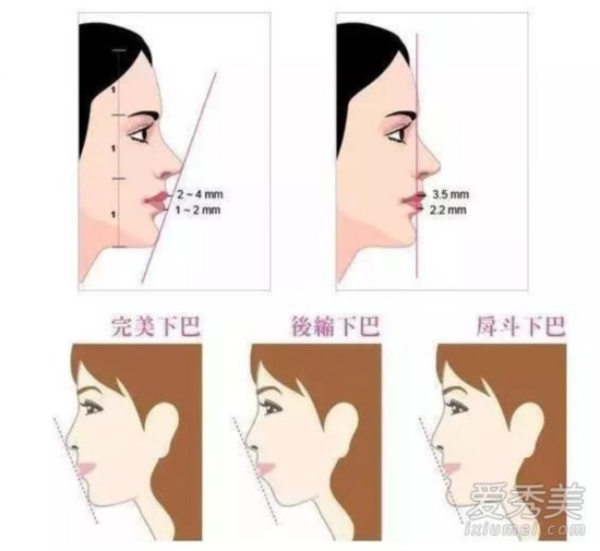 面部美学标准之中,鼻尖,上唇珠,下唇珠和下巴应该在一条直线上,如果